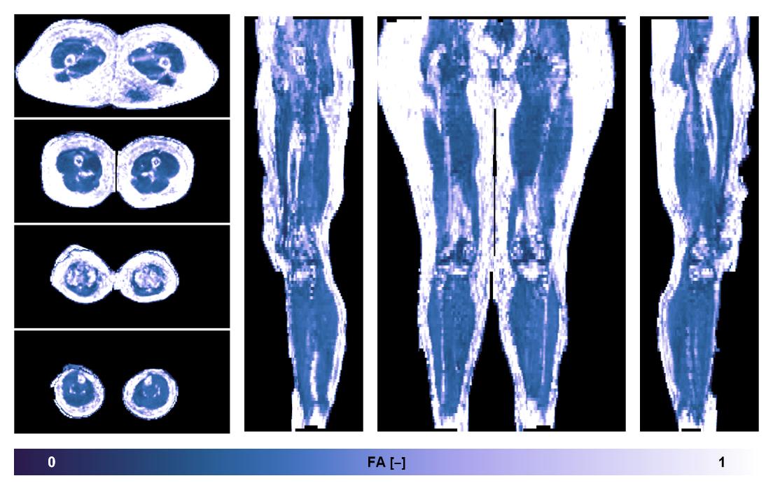 IVIM corrected whole leg muscle fractional anisotropy obtained from diffusion tensor imaging.